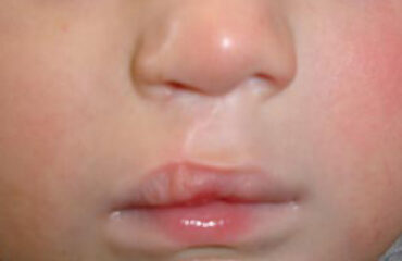 orofacial myology repaired cleft lip still drooling