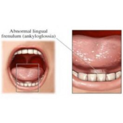 orofacial myology: Tongue Tie 101 for SLPs: What Is Our Role?