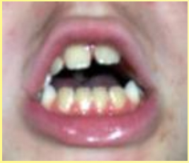 Malocclusion- and- Open-Bite-orofacial-myology