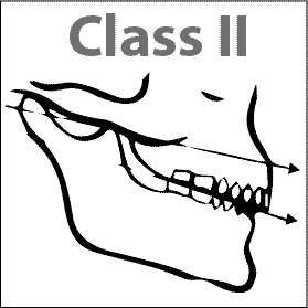 orofacial-myology-class-ii