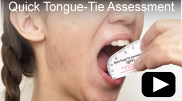 orofacial-myology-quick-tongue-tie-assessment