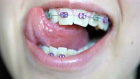 myofunctional-therapy-speech-therapy-and-orthodontics
