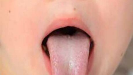 orofacial-myology-child-long-tongue